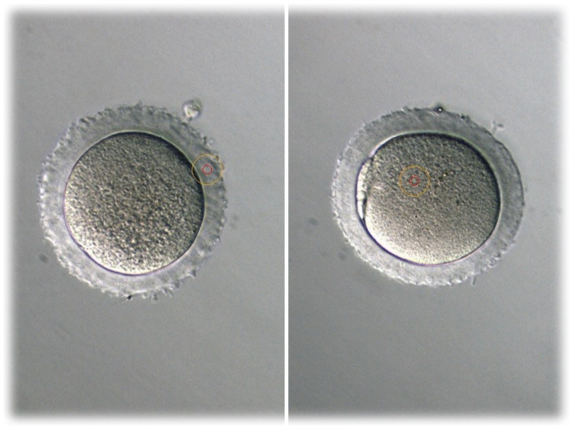 5. 蜡样透明带卵子如果显微镜下未观察到第一极体，是否继续行ICSI？