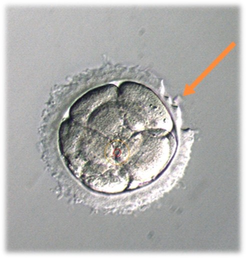 4. 针对蜡样透明带形成的胚胎，冷冻或者移植前需要打薄透明带（部分辅助孵化）吗？